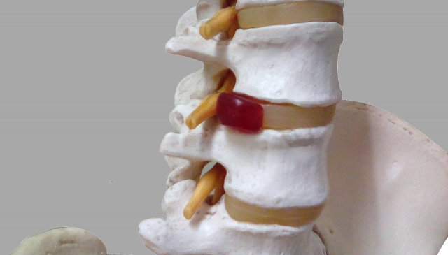 腰椎椎間板ヘルニアのイメージ